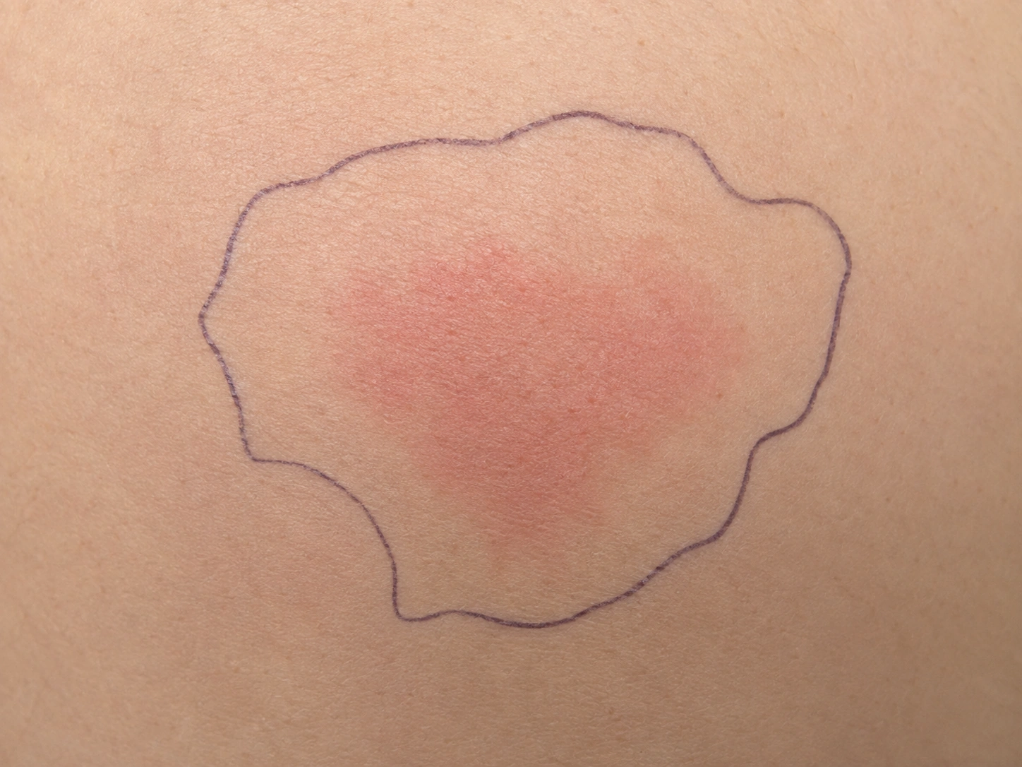 A patch of reddened skin on a thigh with a pen line drawn around the edge of the redness; the red area sits well inside the line.